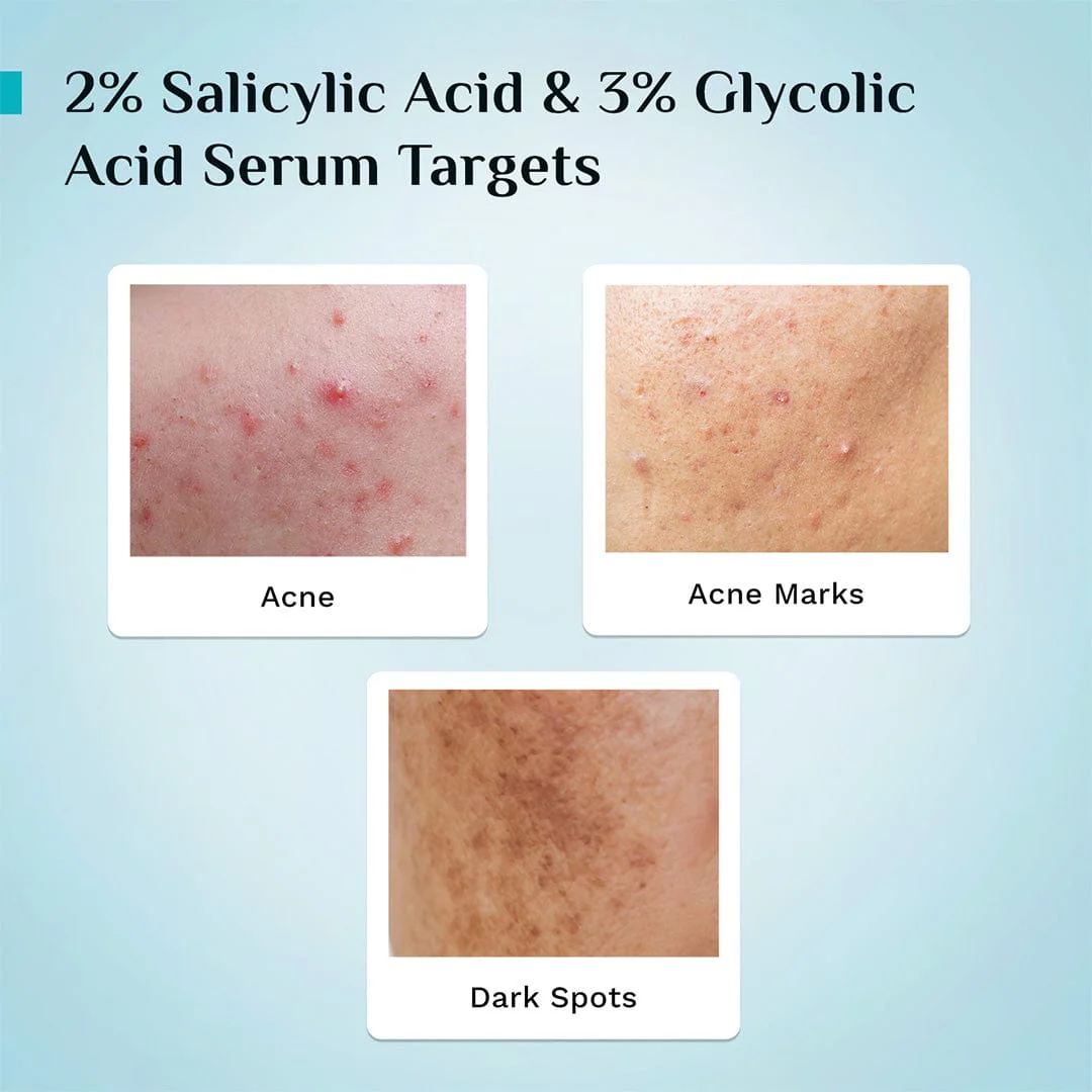2% Salicylic Acid Anti-Acne Face Serum - Image 5